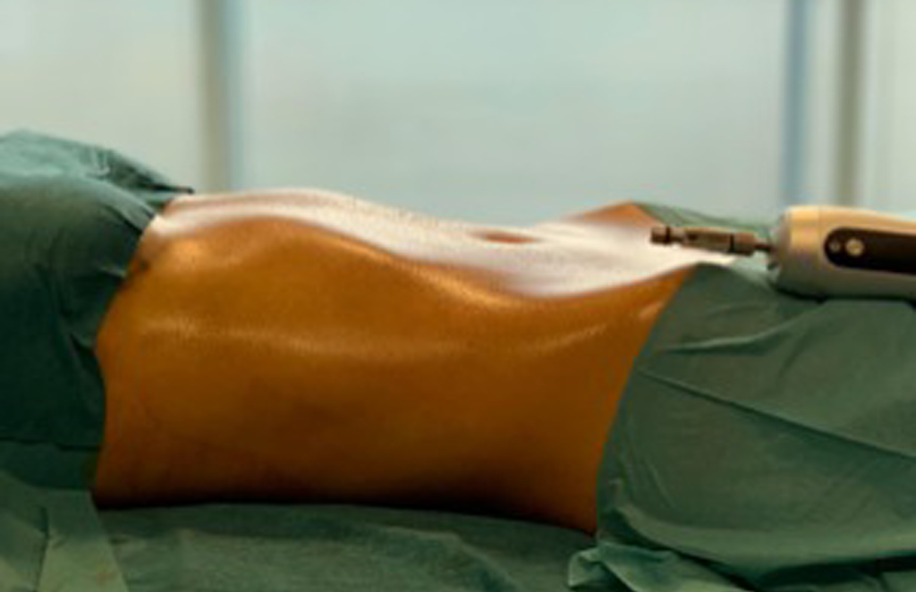 Lipoaspiração FAQ: principais perguntas e respostas