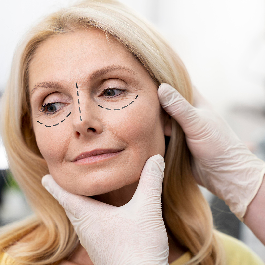 Blefaroplastia: a cirurgia de rejuvenescimento nas pálpebras