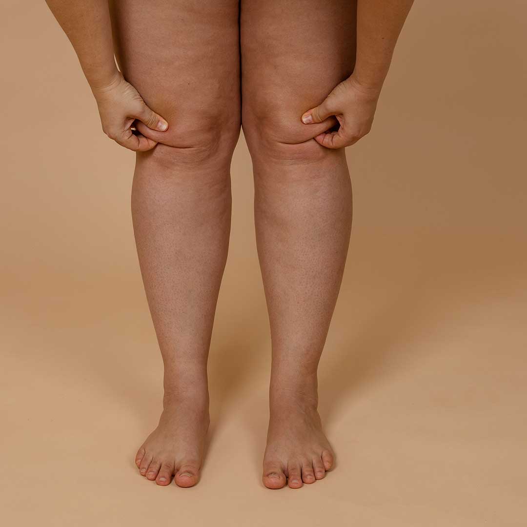 Gerenciamento do Lipedema: estratégias de tratamento e controle de sintomas
